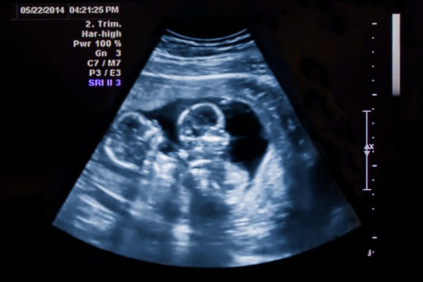 Dra. Thaline Neves explica o que é a síndrome da transfusão feto-fetal e quais são as principais formas de tratamento.